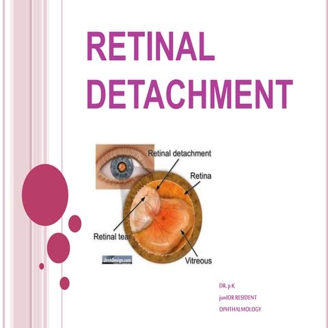 RETINAL DETACHMENT