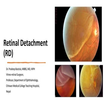 Retinal Detachment_Pradeep Bastola.pptx