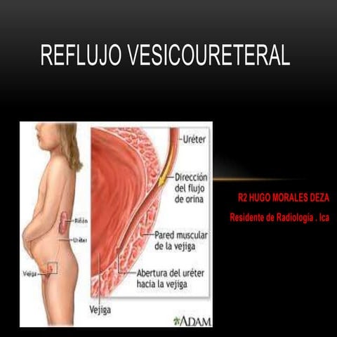 Reflujo vesico ureteral