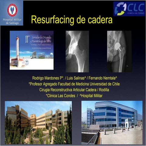 Resurfacing De Cadera
