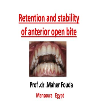 Retention of open bite 