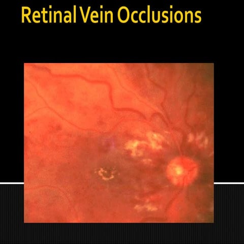 Retinal vein occlusions 