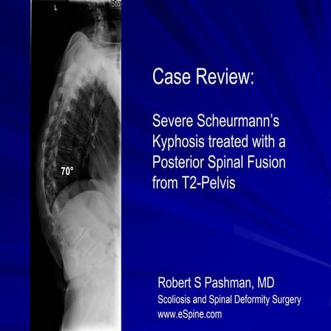 Case Review 4: A 58 year old female presented with Scheurmann's Kyphosis