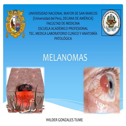 MELANOMAS