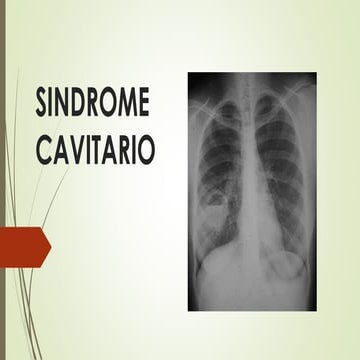 Sindrome cavitario