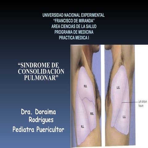 SINDROME DE CONSOLIDACIÓN: Neumonía y Atelectasia