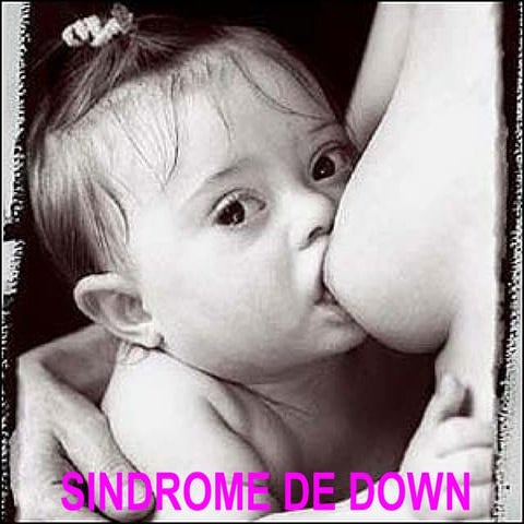 Sindromededown