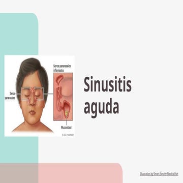 SINUSITIS AGUDA PEDIATRIA, DX Y TTO.pptx