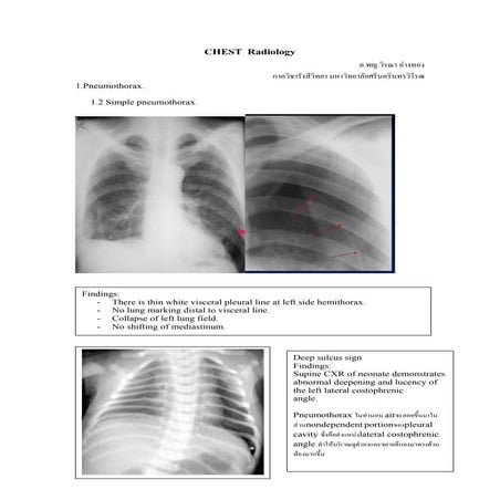 SWU  CXR interpretation