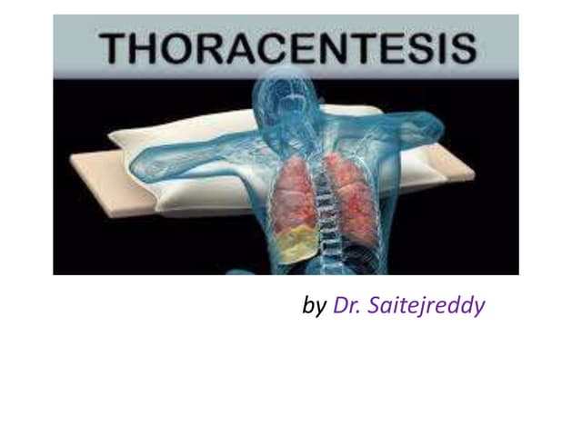 thoracocentesis-141