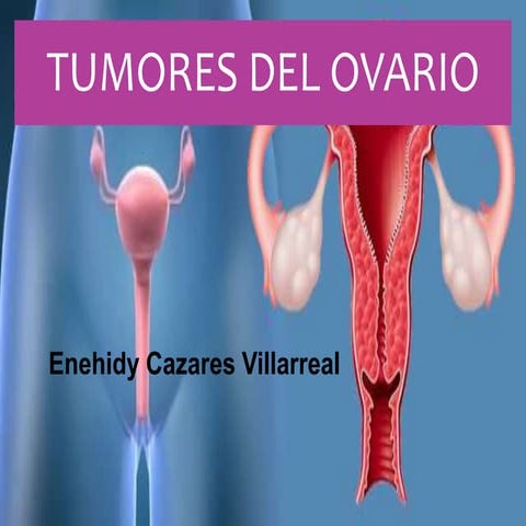 Tumores del ovario. Patologia clinica DE pORTH