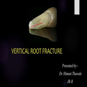 Vertical root fracture