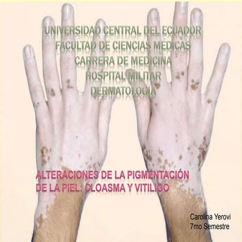 Trastornos de la pigmentación de la piel: Vitiligo, Cloasma