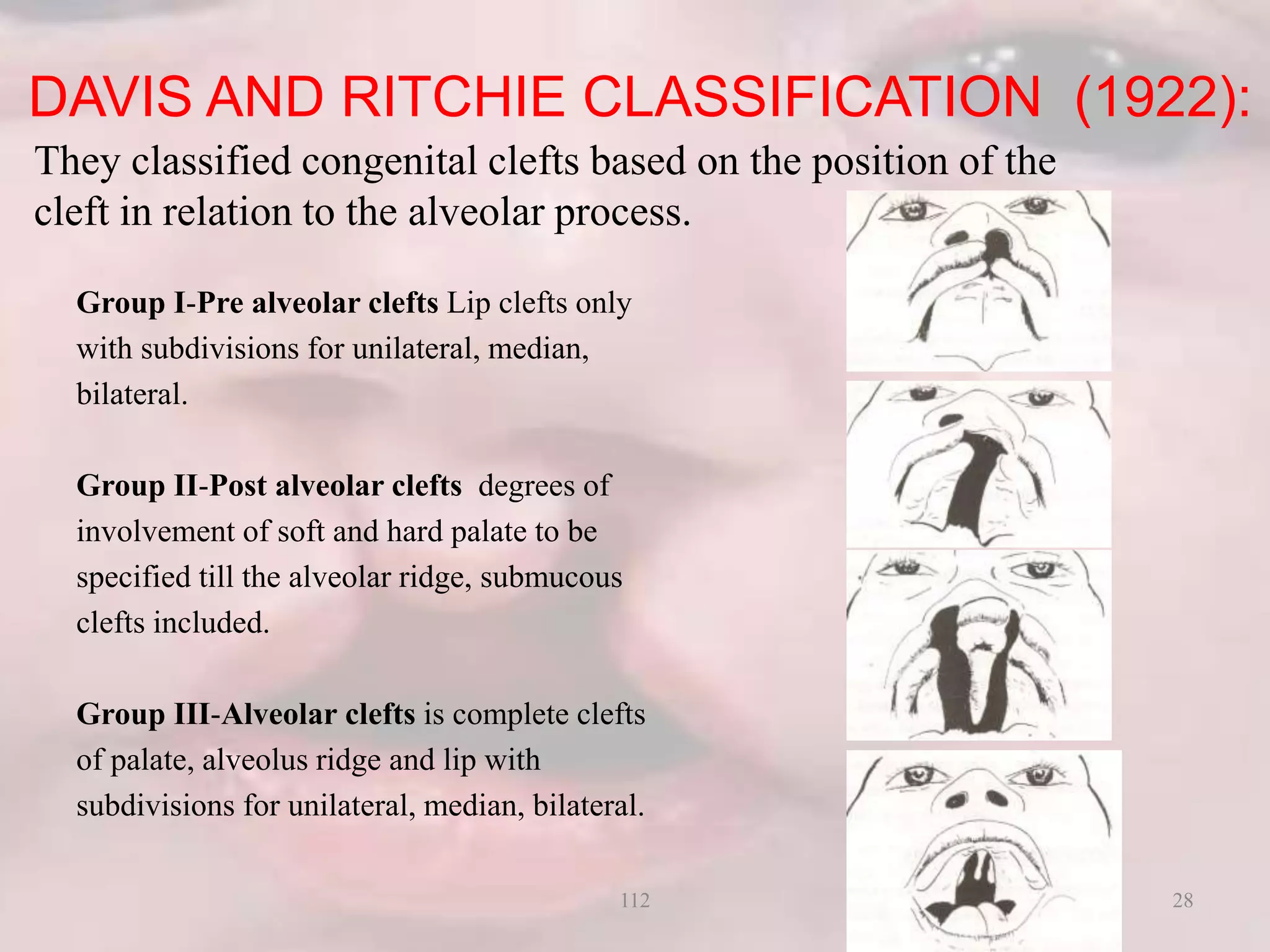 DAVIS AND RITCHIE CLASSIFICATION (1922):
Group I-Pre alveolar clefts Lip clefts only
with subdivisions for unilateral, median,
bilateral.
Group II-Post alveolar clefts degrees of
involvement of soft and hard palate to be
specified till the alveolar ridge, submucous
clefts included.
Group III-Alveolar clefts is complete clefts
of palate, alveolus ridge and lip with
subdivisions for unilateral, median, bilateral.
They classified congenital clefts based on the position of the
cleft in relation to the alveolar process.
28112
 