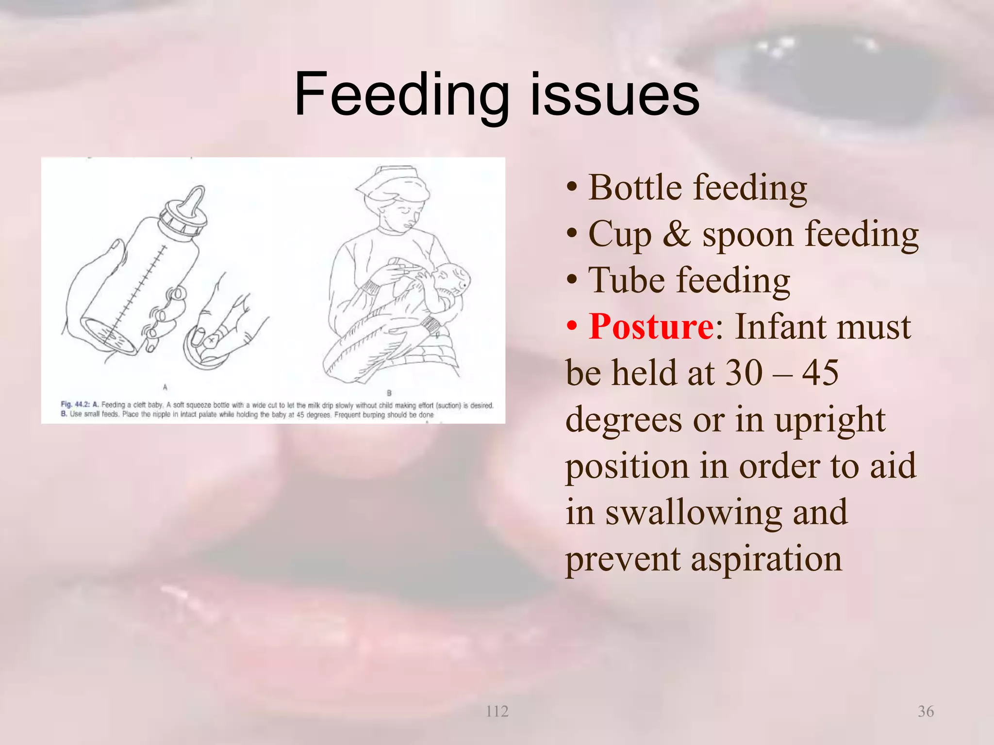 Feeding issues
• Bottle feeding
• Cup & spoon feeding
• Tube feeding
• Posture: Infant must
be held at 30 – 45
degrees or in upright
position in order to aid
in swallowing and
prevent aspiration
36112
 