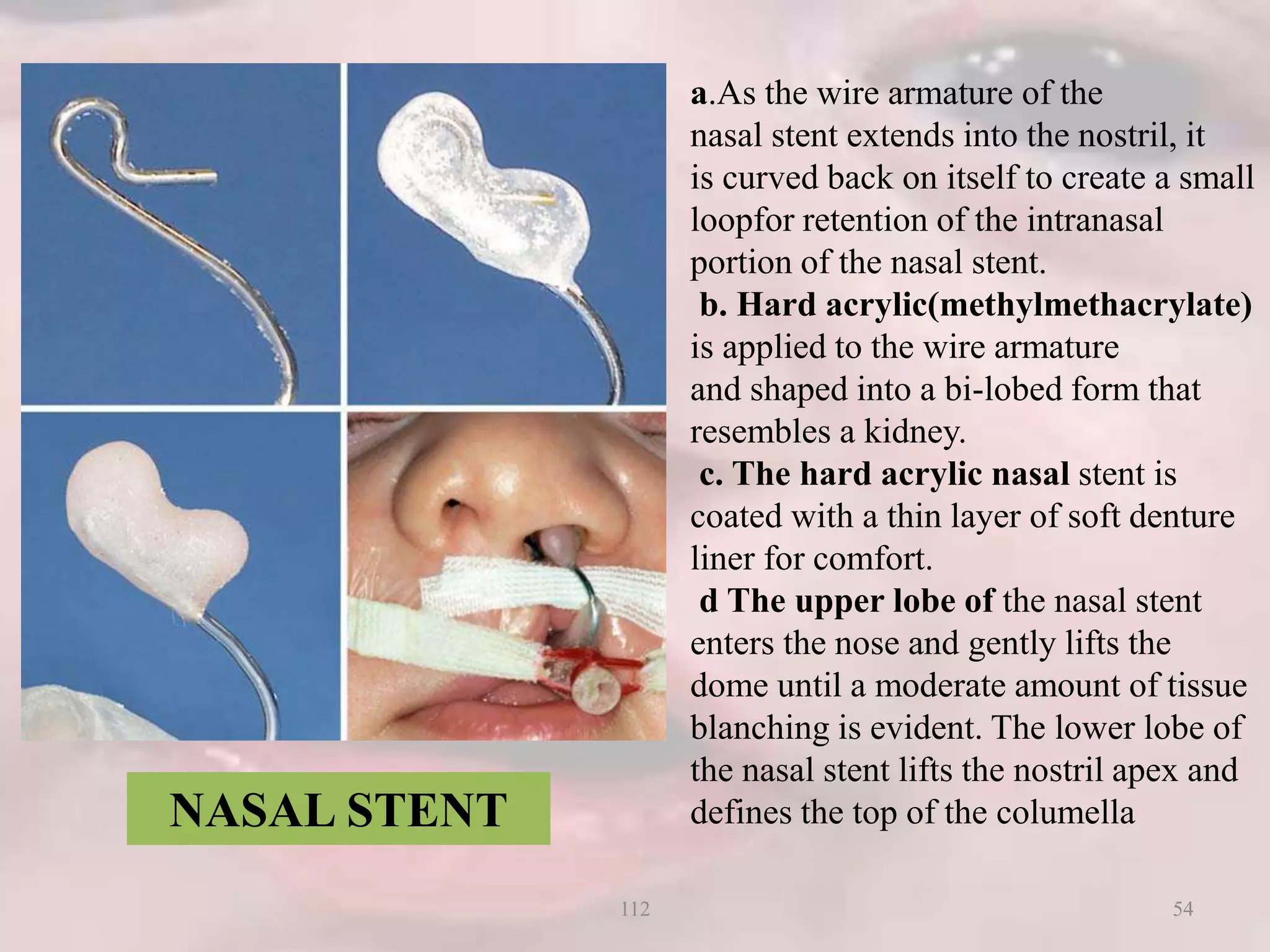 a.As the wire armature of the
nasal stent extends into the nostril, it
is curved back on itself to create a small
loopfor retention of the intranasal
portion of the nasal stent.
b. Hard acrylic(methylmethacrylate)
is applied to the wire armature
and shaped into a bi-lobed form that
resembles a kidney.
c. The hard acrylic nasal stent is
coated with a thin layer of soft denture
liner for comfort.
d The upper lobe of the nasal stent
enters the nose and gently lifts the
dome until a moderate amount of tissue
blanching is evident. The lower lobe of
the nasal stent lifts the nostril apex and
defines the top of the columellaNASAL STENT
54112
 