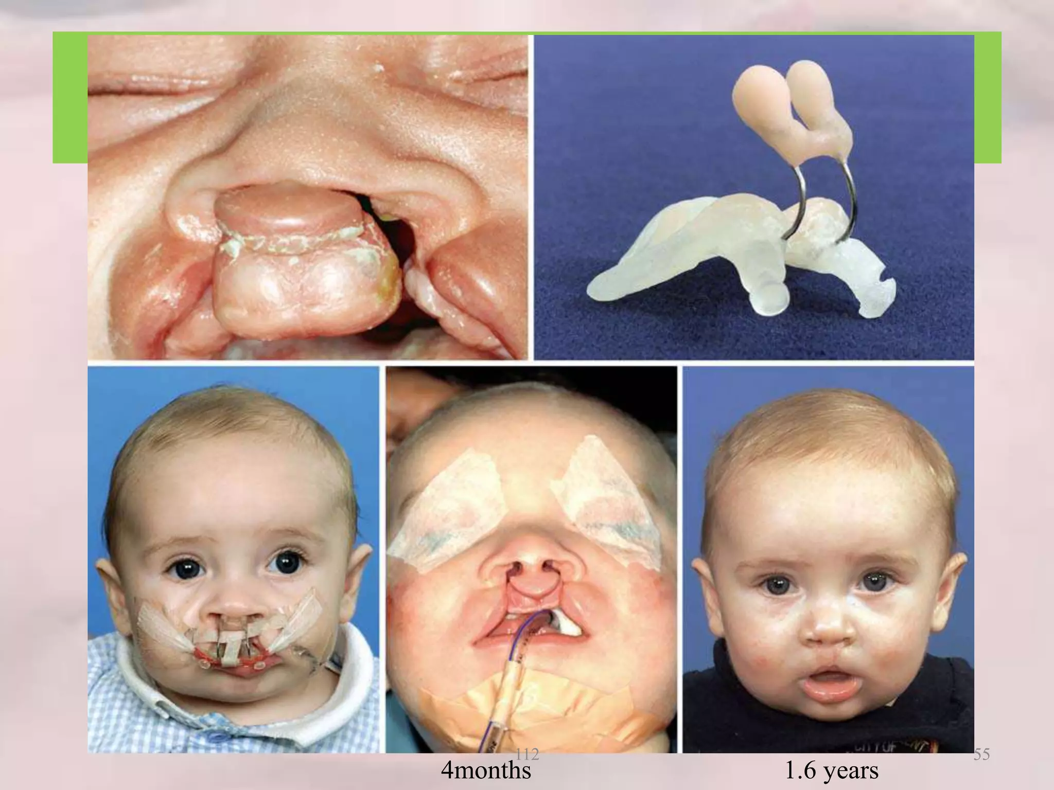 Bilateral complete cleft
4months 1.6 years
55112
 