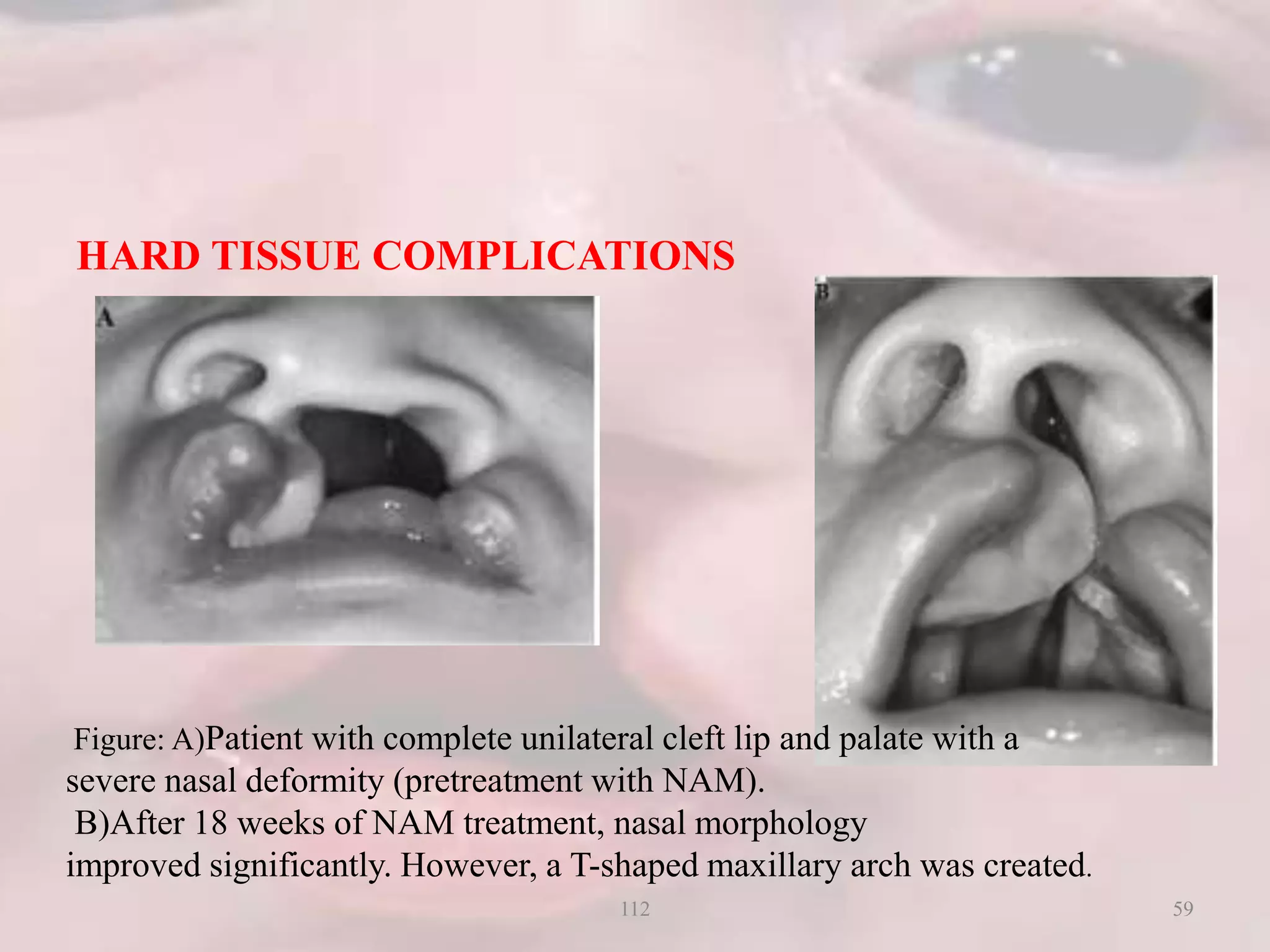 HARD TISSUE COMPLICATIONS
Figure: A)Patient with complete unilateral cleft lip and palate with a
severe nasal deformity (pretreatment with NAM).
B)After 18 weeks of NAM treatment, nasal morphology
improved significantly. However, a T-shaped maxillary arch was created.
59112
 