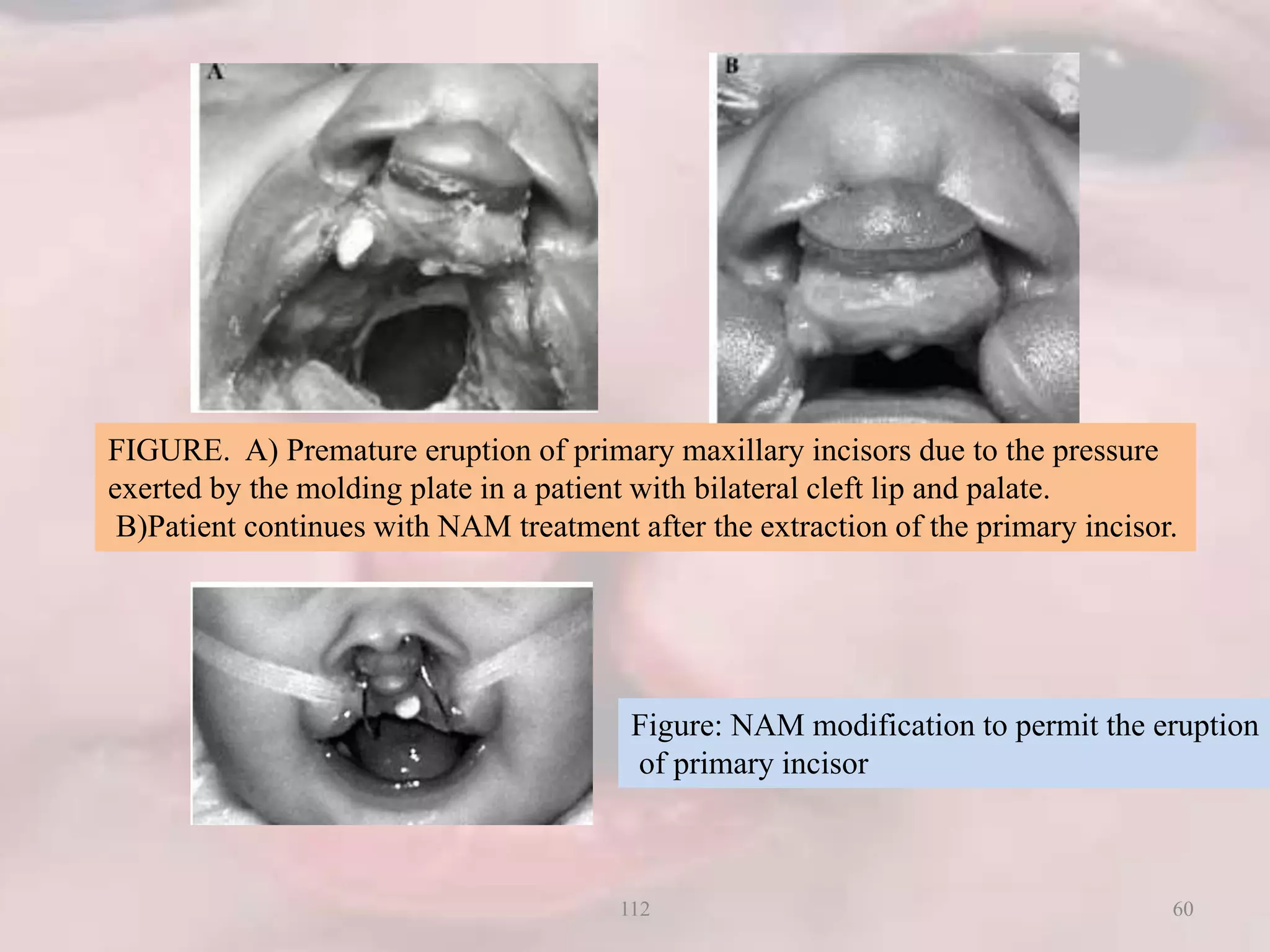 FIGURE. A) Premature eruption of primary maxillary incisors due to the pressure
exerted by the molding plate in a patient with bilateral cleft lip and palate.
B)Patient continues with NAM treatment after the extraction of the primary incisor.
Figure: NAM modification to permit the eruption
of primary incisor
60112
 