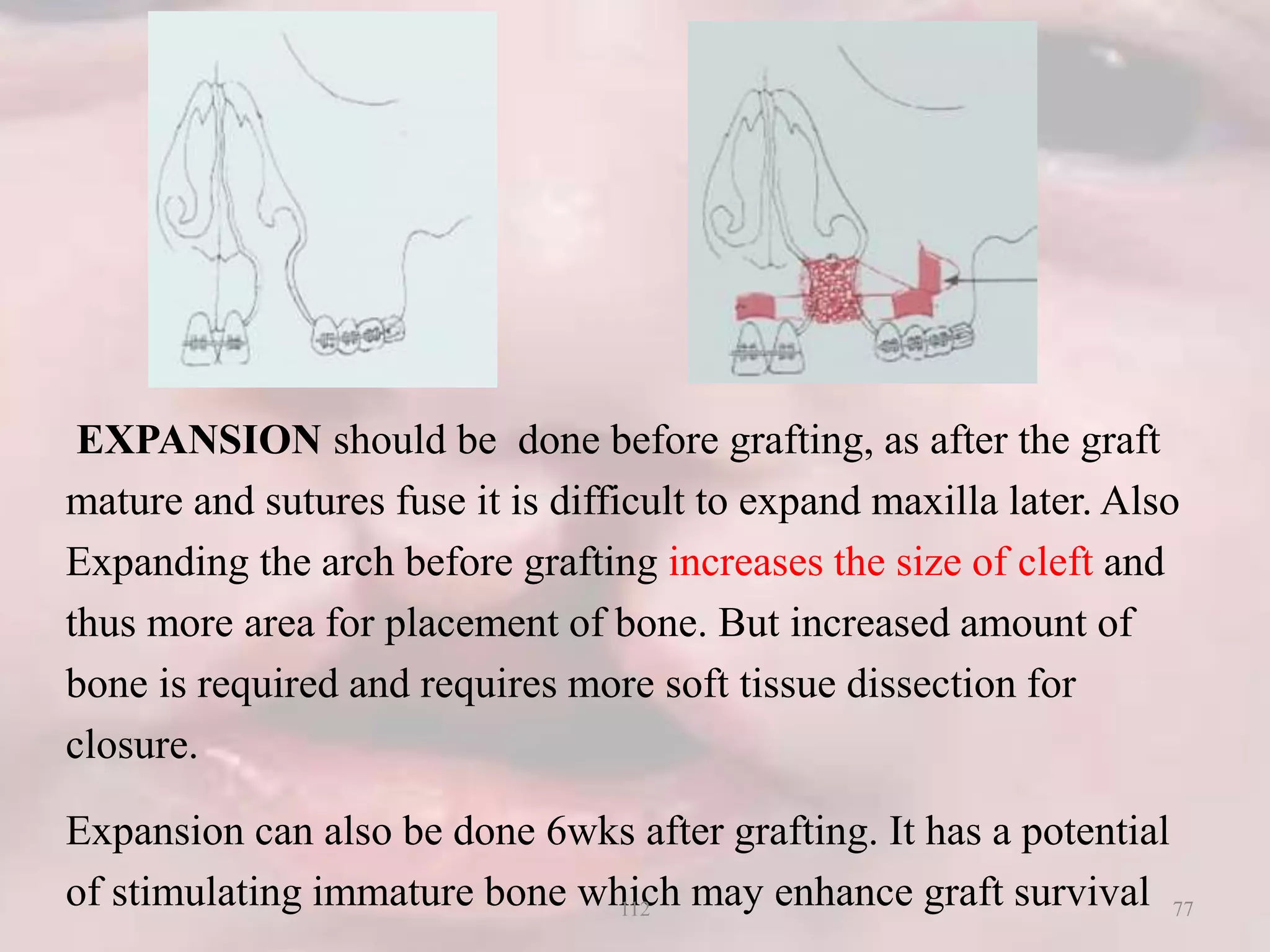 EXPANSION should be done before grafting, as after the graft
mature and sutures fuse it is difficult to expand maxilla later. Also
Expanding the arch before grafting increases the size of cleft and
thus more area for placement of bone. But increased amount of
bone is required and requires more soft tissue dissection for
closure.
Expansion can also be done 6wks after grafting. It has a potential
of stimulating immature bone which may enhance graft survival 77112
 