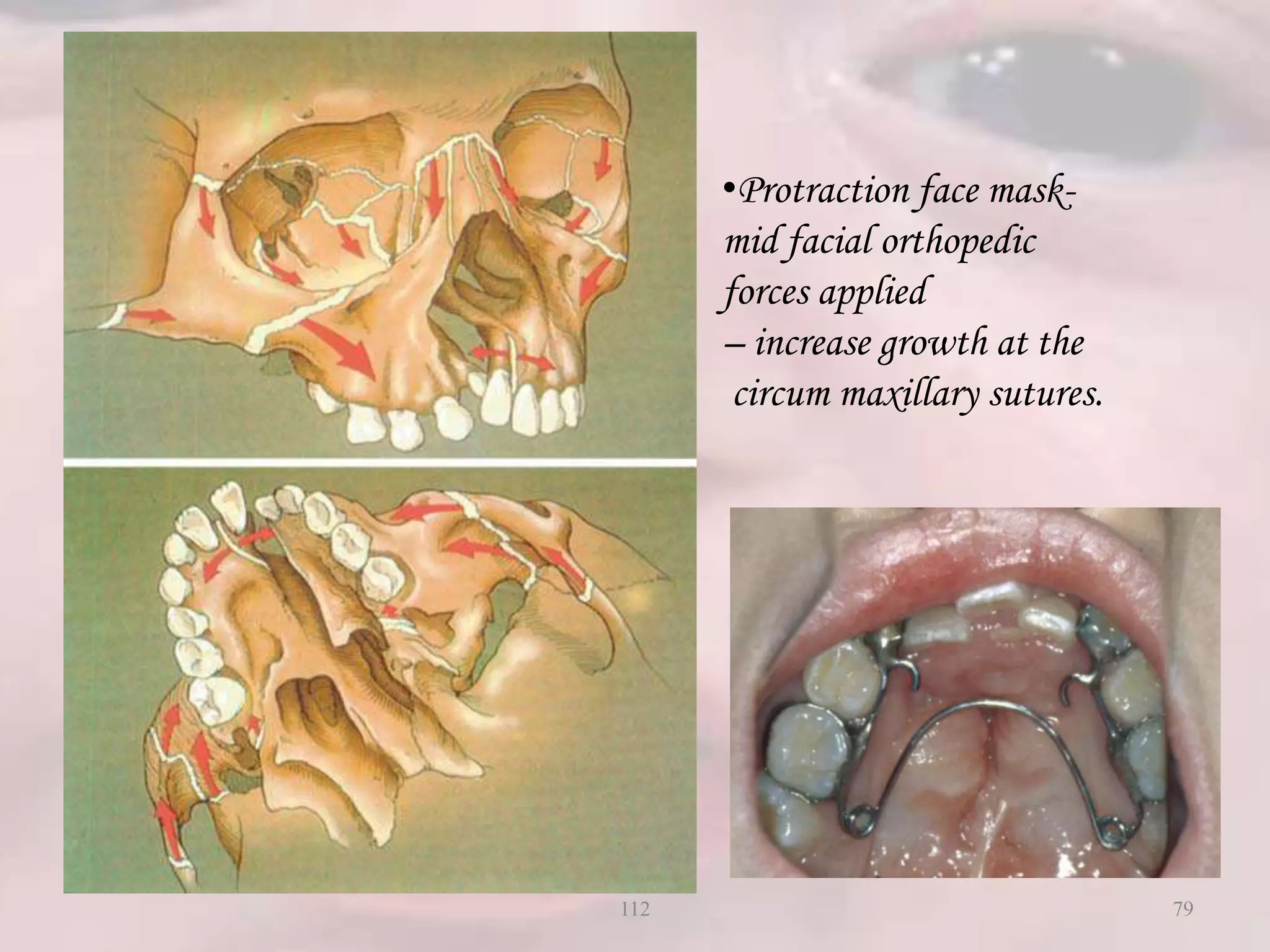 •Protraction face mask-
mid facial orthopedic
forces applied
– increase growth at the
circum maxillary sutures.
79112
 