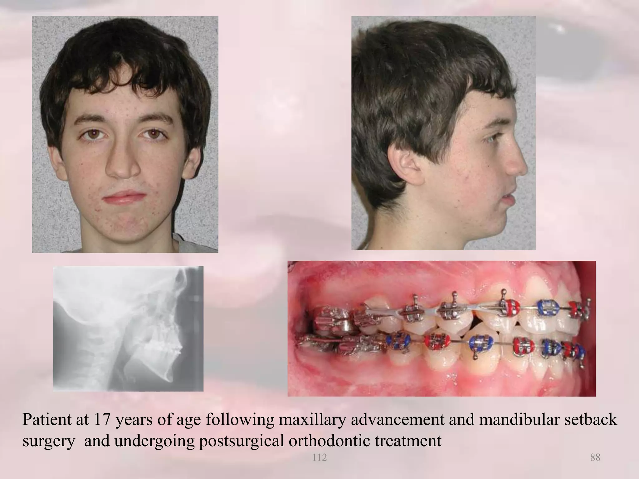 Patient at 17 years of age following maxillary advancement and mandibular setback
surgery and undergoing postsurgical orthodontic treatment
88112
 