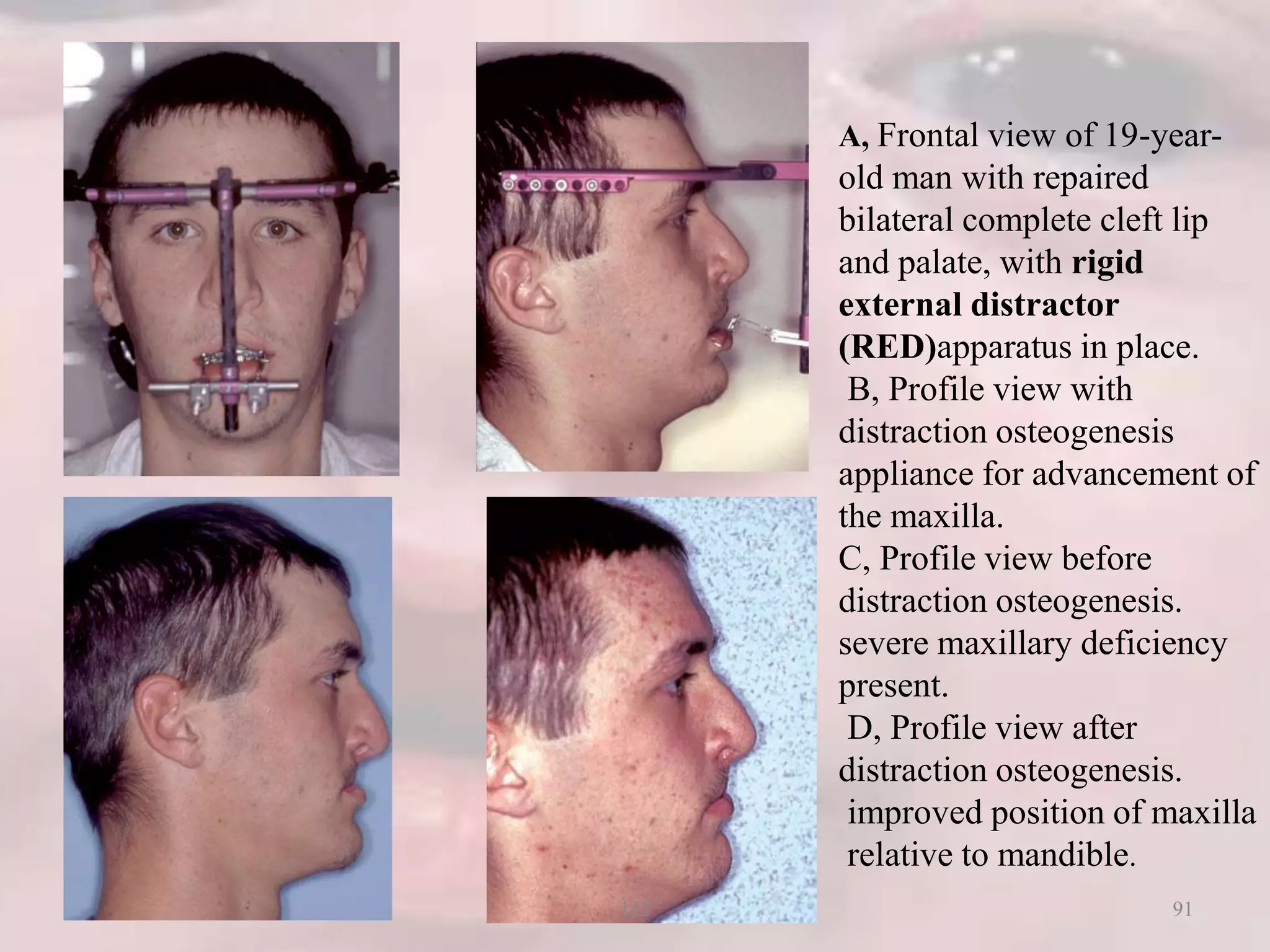 A, Frontal view of 19-year-
old man with repaired
bilateral complete cleft lip
and palate, with rigid
external distractor
(RED)apparatus in place.
B, Profile view with
distraction osteogenesis
appliance for advancement of
the maxilla.
C, Profile view before
distraction osteogenesis.
severe maxillary deficiency
present.
D, Profile view after
distraction osteogenesis.
improved position of maxilla
relative to mandible.
91112
 