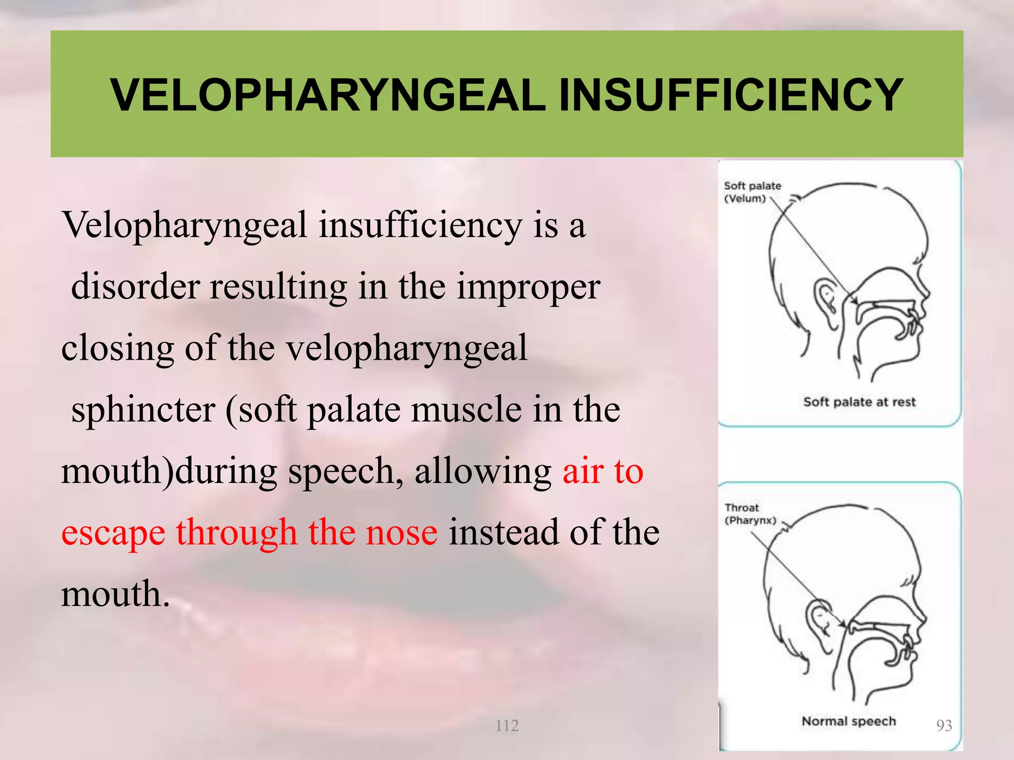 VELOPHARYNGEAL INSUFFICIENCY
Velopharyngeal insufficiency is a
disorder resulting in the improper
closing of the velopharyngeal
sphincter (soft palate muscle in the
mouth)during speech, allowing air to
escape through the nose instead of the
mouth.
93112
 