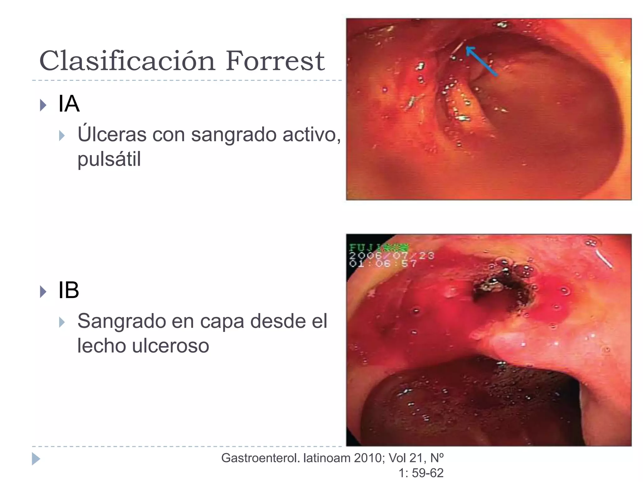 Clasificación Forrest
   IA
       Úlceras con sangrado activo,
        pulsátil




   IB
       Sangrado en capa desde el
        lecho ulceroso




                       Gastroenterol. latinoam 2010; Vol 21, Nº
                                                      1: 59-62
 