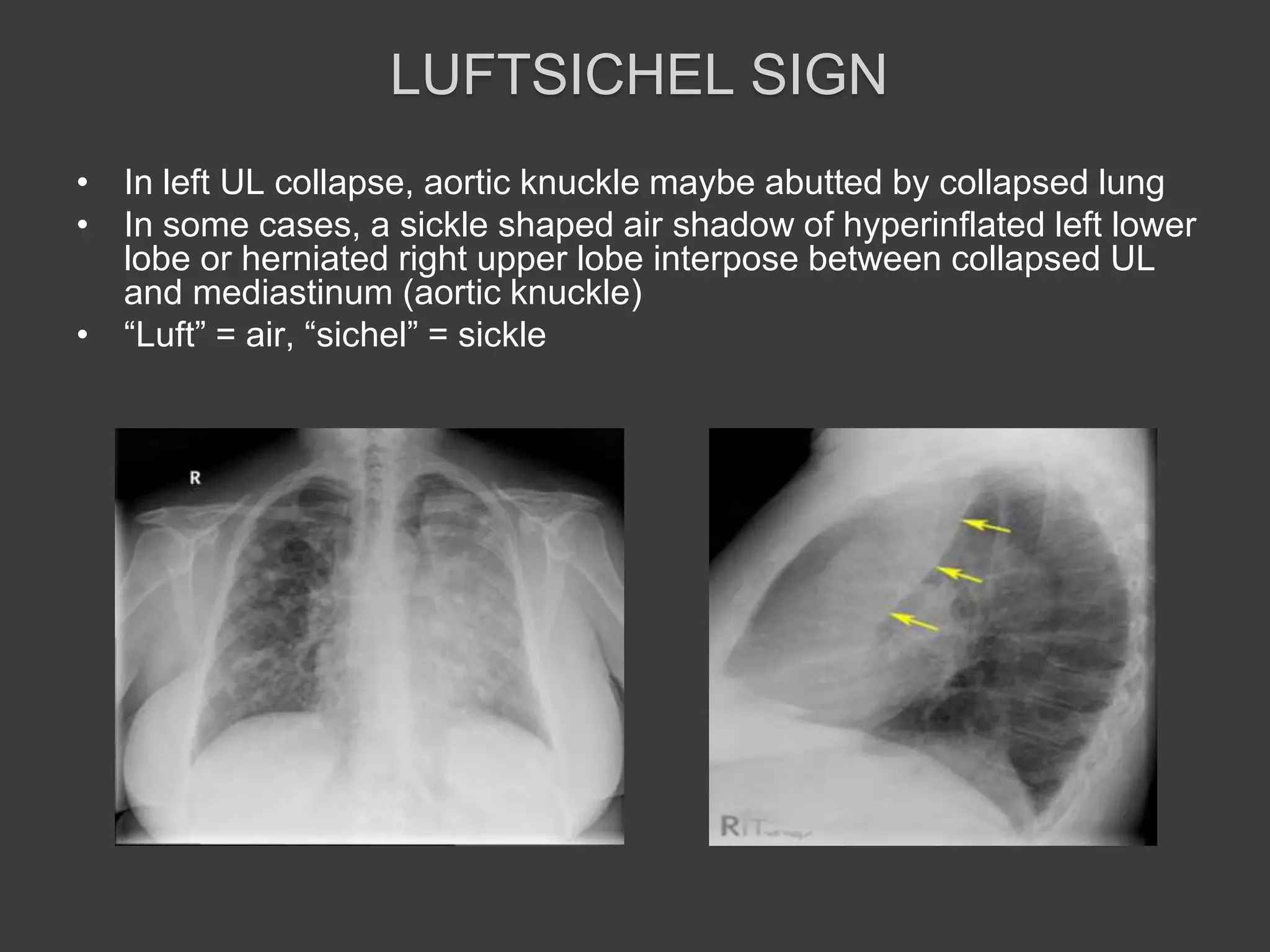 LUFTSICHEL SIGN
• In left UL collapse, aortic knuckle maybe abutted by collapsed lung
• In some cases, a sickle shaped air shadow of hyperinflated left lower
lobe or herniated right upper lobe interpose between collapsed UL
and mediastinum (aortic knuckle)
• “Luft” = air, “sichel” = sickle
 