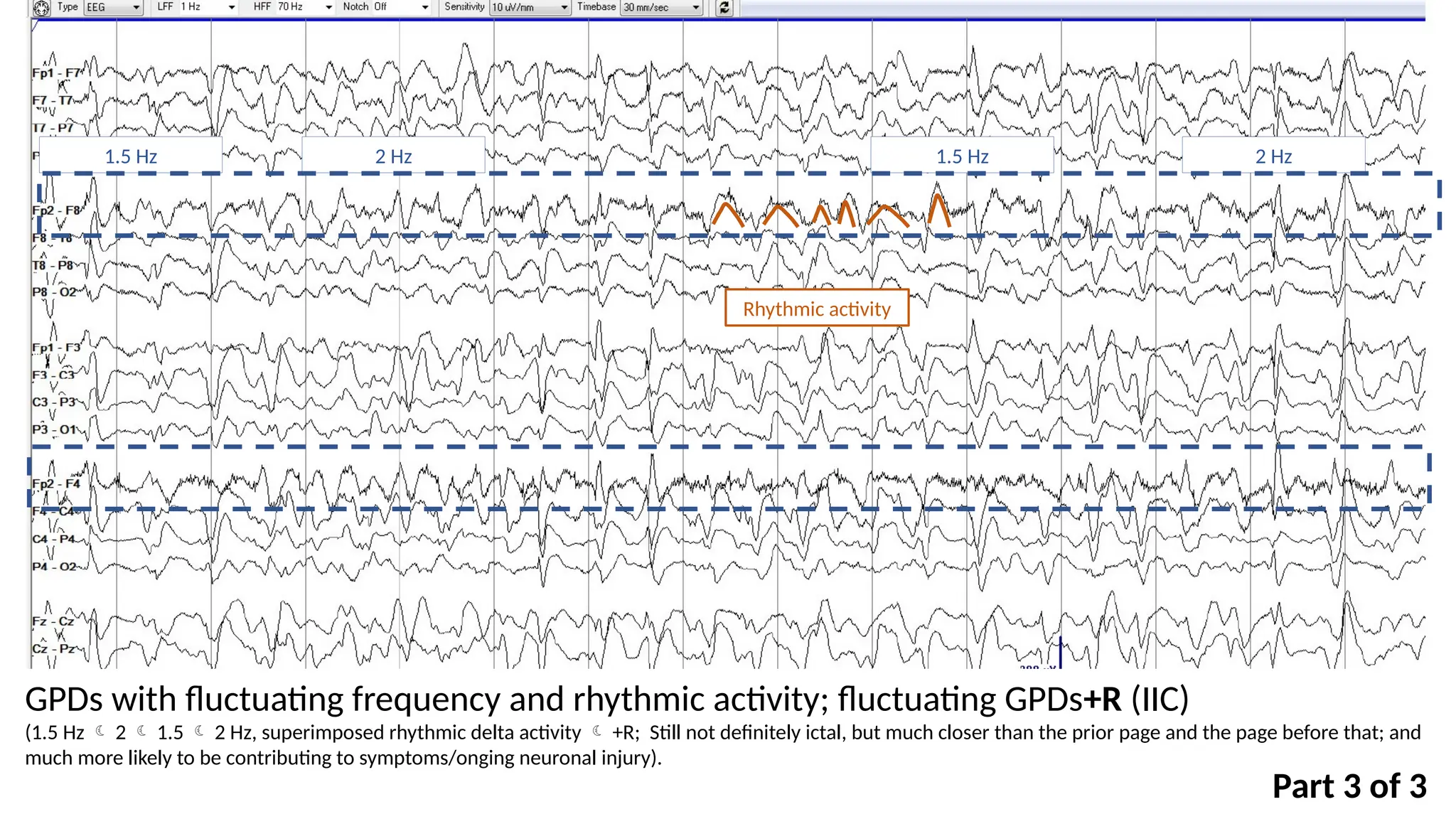 GPDs with fluctuating frequency and rhythmic activity; fluctuating GPDs+R (IIC)
(1.5 Hz  2  1.5  2 Hz, superimposed rhythmic delta activity  +R; Still not definitely ictal, but much closer than the prior page and the page before that; and
much more likely to be contributing to symptoms/onging neuronal injury).
1.5 Hz 2 Hz 1.5 Hz 2 Hz
Rhythmic activity
Part 3 of 3
 