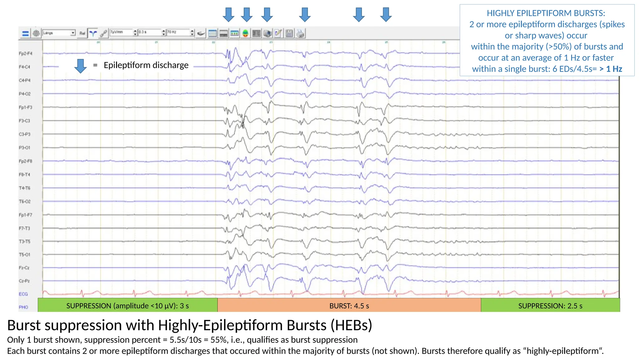 HIGHLY EPILEPTIFORM BURSTS:
2 or more epileptiform discharges (spikes
or sharp waves) occur
within the majority (>50%) of bursts and
occur at an average of 1 Hz or faster
within a single burst: 6 EDs/4.5s= > 1 Hz
= Epileptiform discharge
Burst suppression pattern, Suppression percent = 5.5s/10s = 55%; Highly epileptiform burst
SUPPRESSION: 2.5 s
SUPPRESSION (amplitude <10 µV): 3 s BURST: 4.5 s
Burst suppression with Highly-Epileptiform Bursts (HEBs)
Only 1 burst shown, suppression percent = 5.5s/10s = 55%, i.e., qualifies as burst suppression
Each burst contains 2 or more epileptiform discharges that occured within the majority of bursts (not shown). Bursts therefore qualify as “highly-epileptiform“.
 