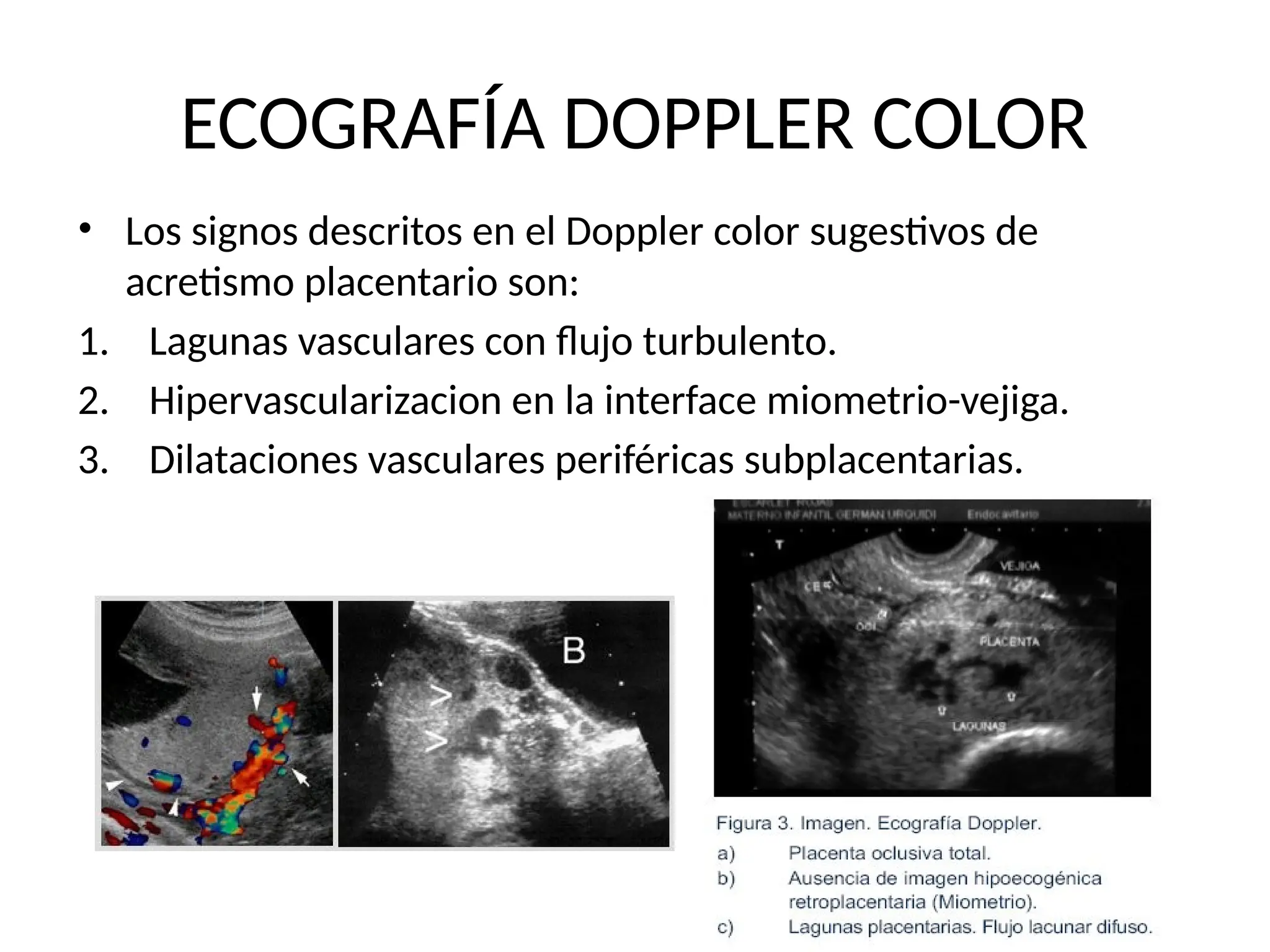 ECOGRAFÍA DOPPLER COLOR
• Los signos descritos en el Doppler color sugestivos de
acretismo placentario son:
1. Lagunas vasculares con flujo turbulento.
2. Hipervascularizacion en la interface miometrio-vejiga.
3. Dilataciones vasculares periféricas subplacentarias.