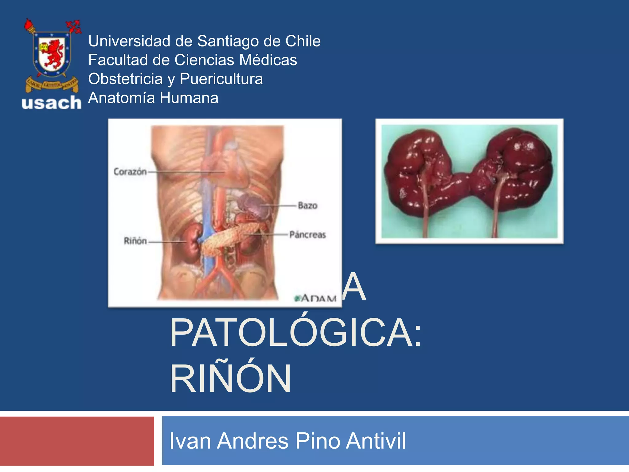 Universidad de Santiago de Chile
Facultad de Ciencias Médicas
Obstetricia y Puericultura
Anatomía Humana




           ANATOMÍA
           PATOLÓGICA:
           RIÑÓN
           Ivan Andres Pino Antivil
 