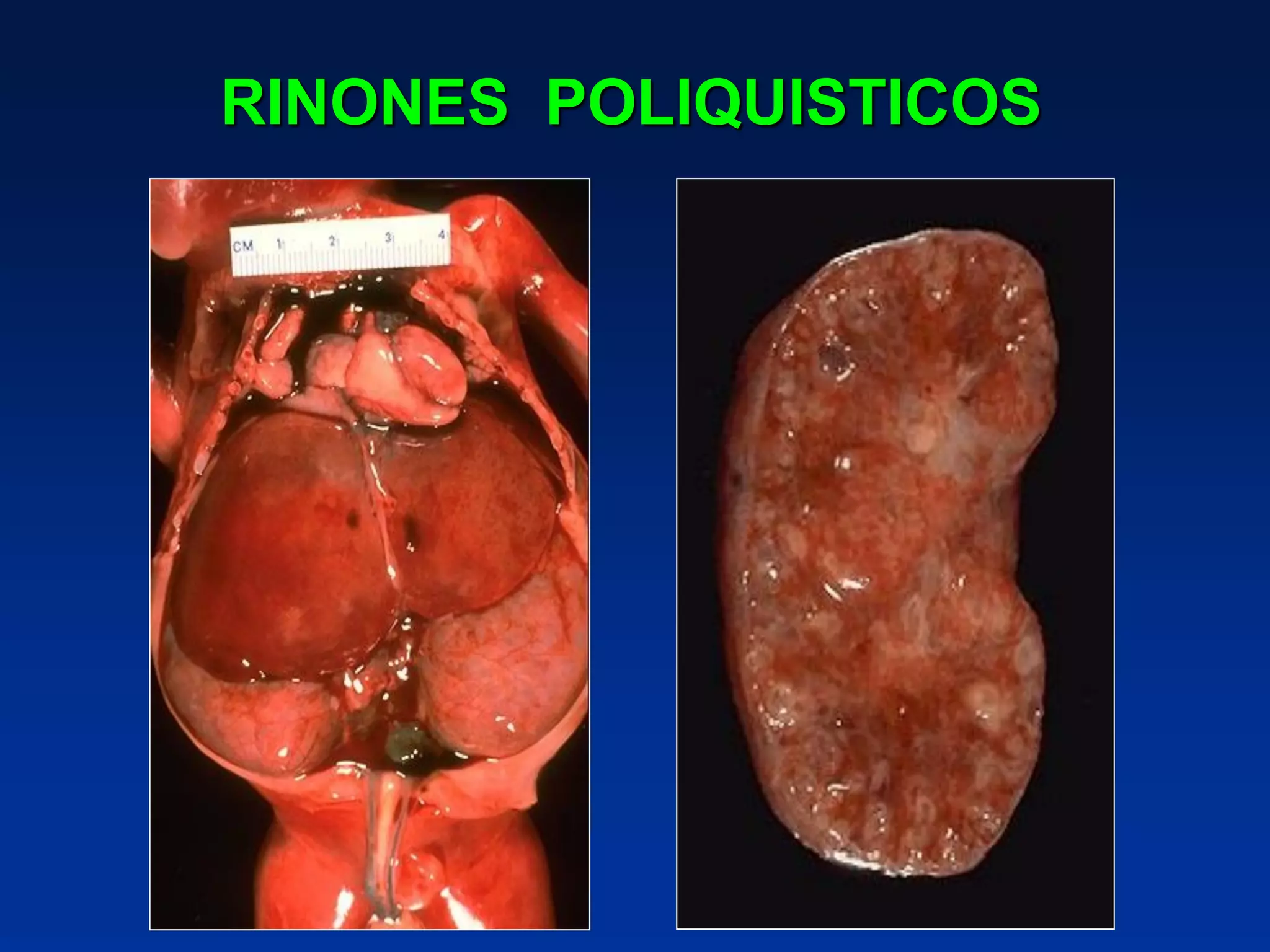 RINONES POLIQUISTICOS
 