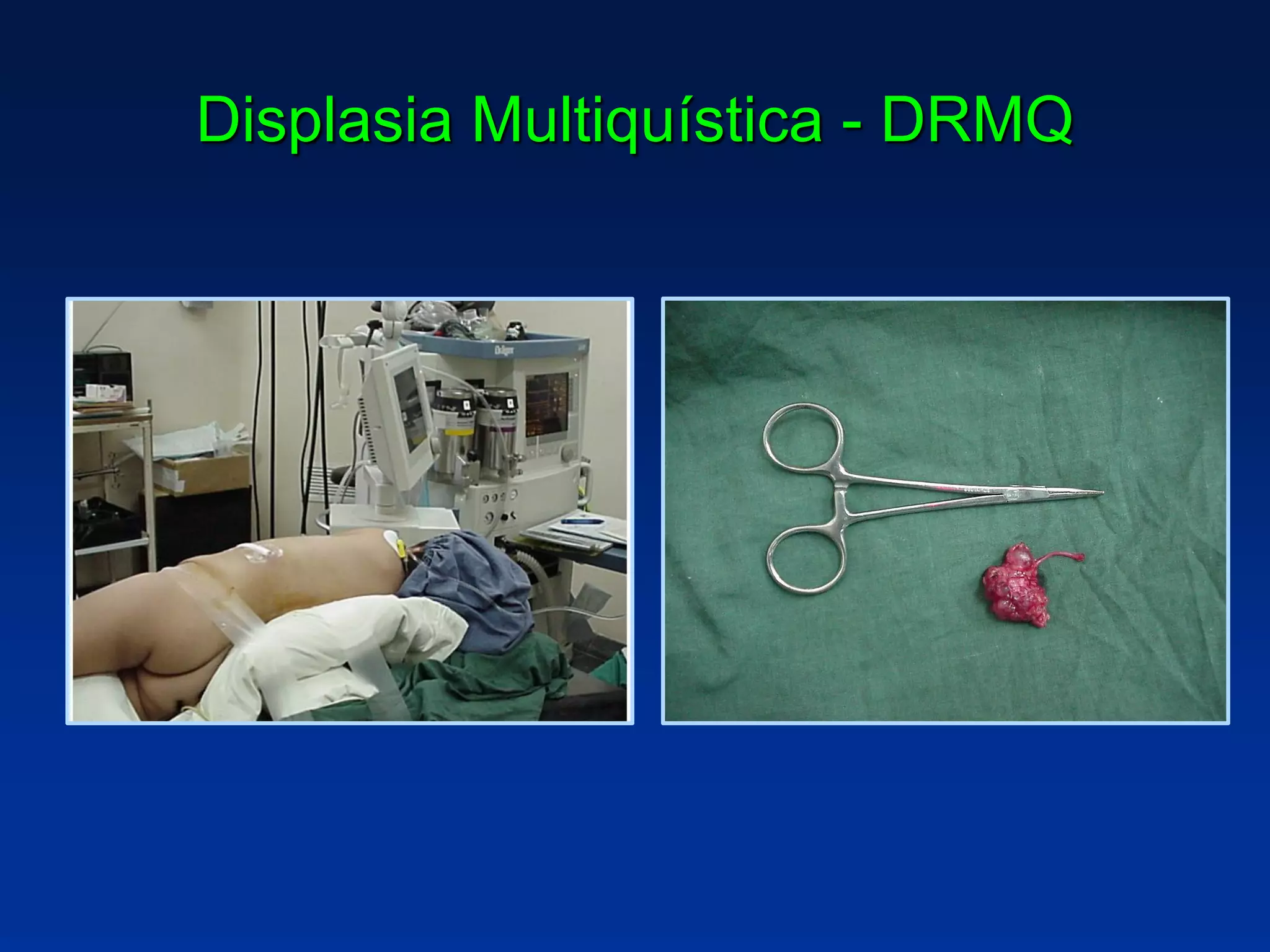 Displasia Multiquística - DRMQ
 