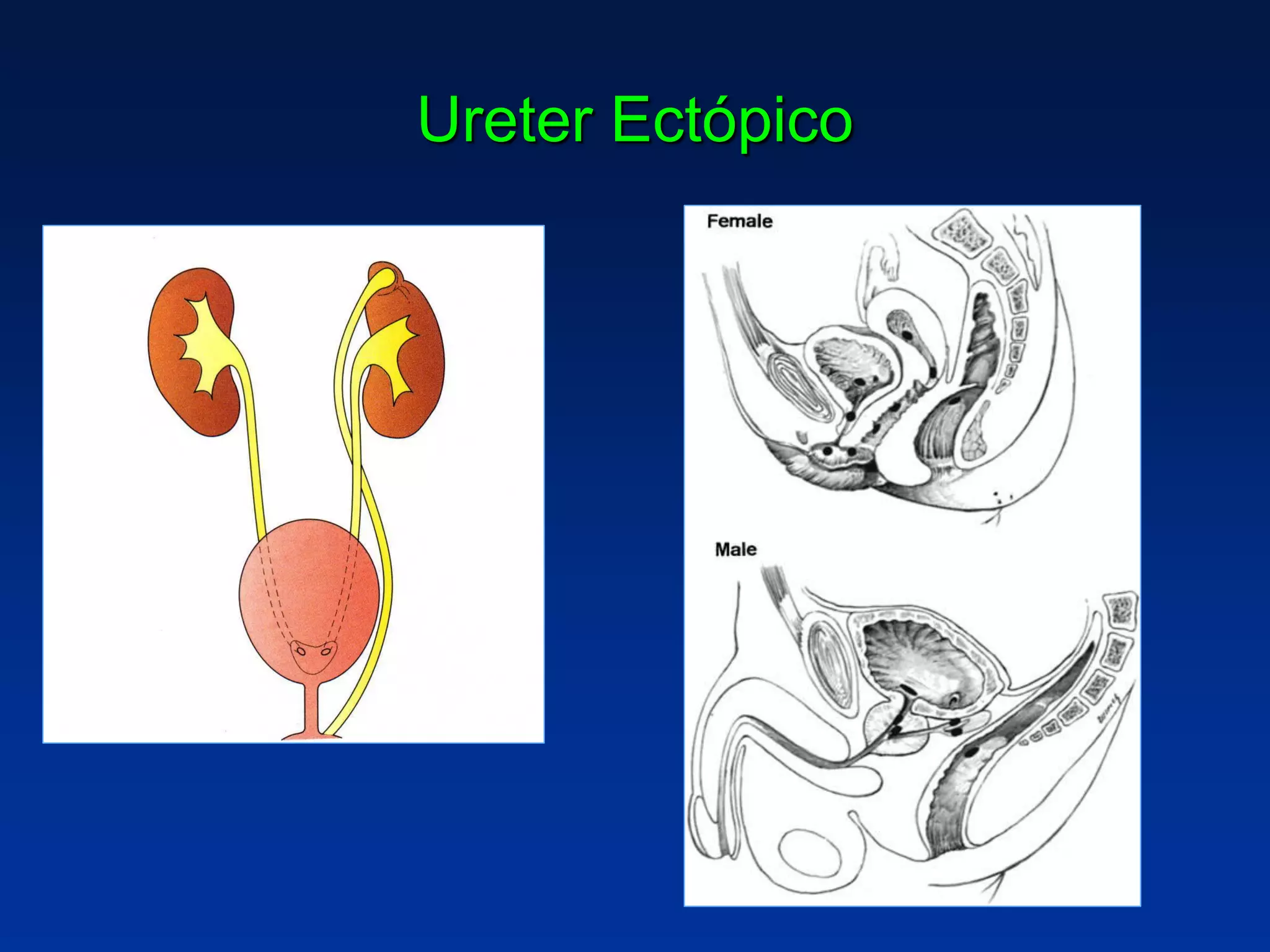 Ureter Ectópico
 