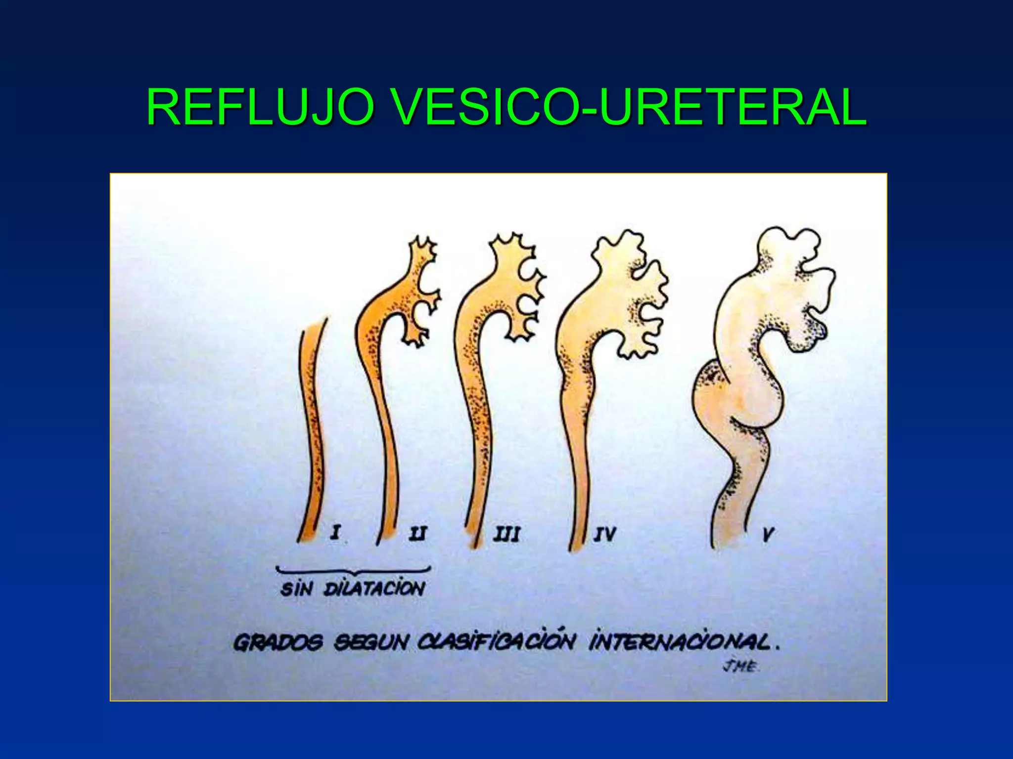 REFLUJO VESICO-URETERAL
 