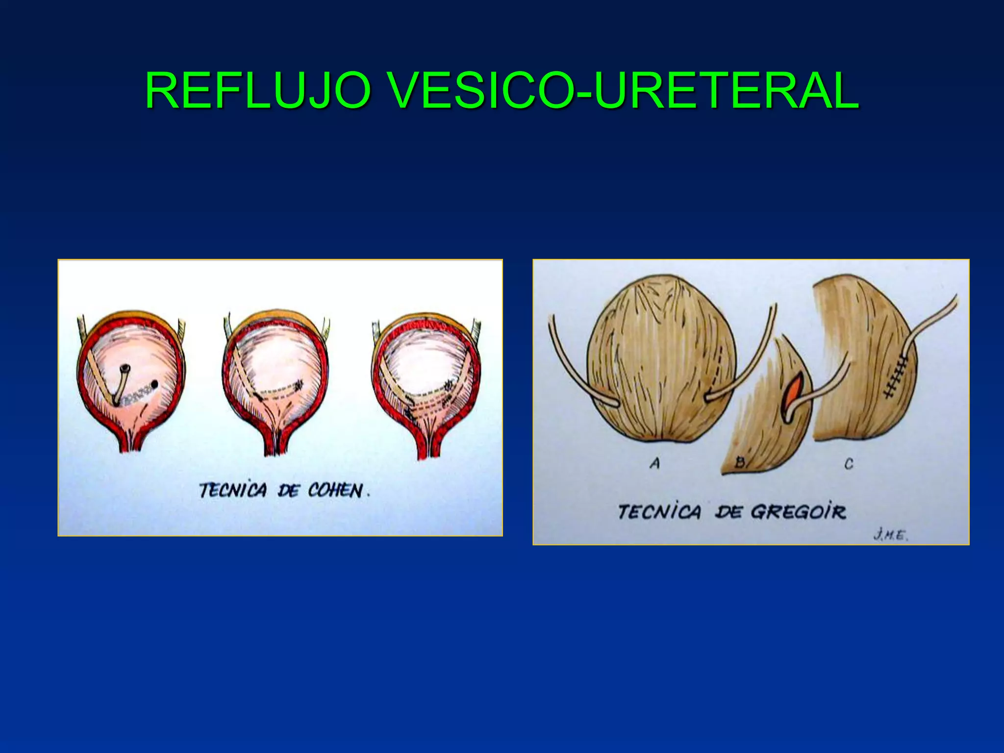 REFLUJO VESICO-URETERAL
 
