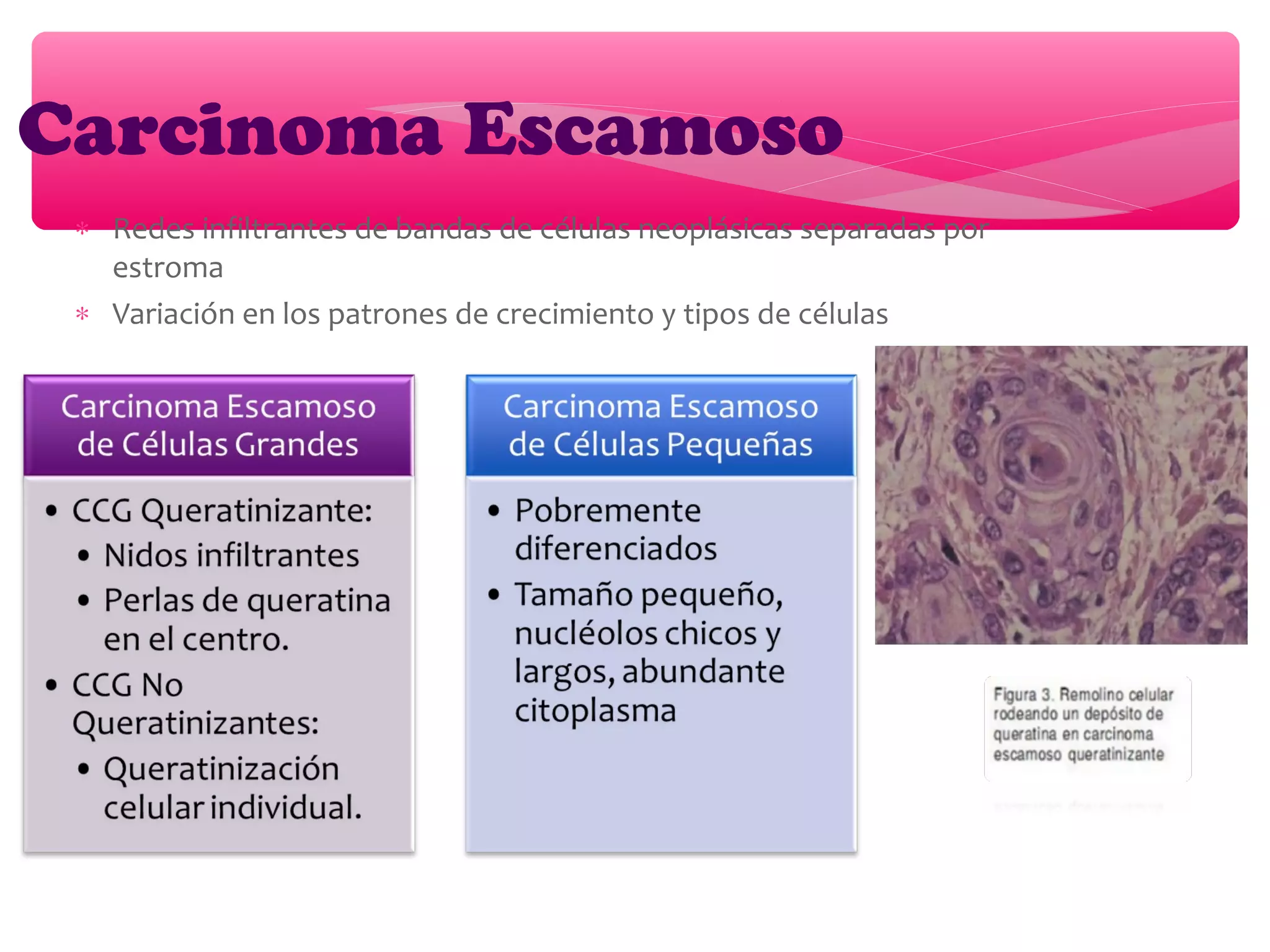 ∗ Redes infiltrantes de bandas de células neoplásicas separadas por
estroma
∗ Variación en los patrones de crecimiento y tipos de células
Carcinoma Escamoso
 