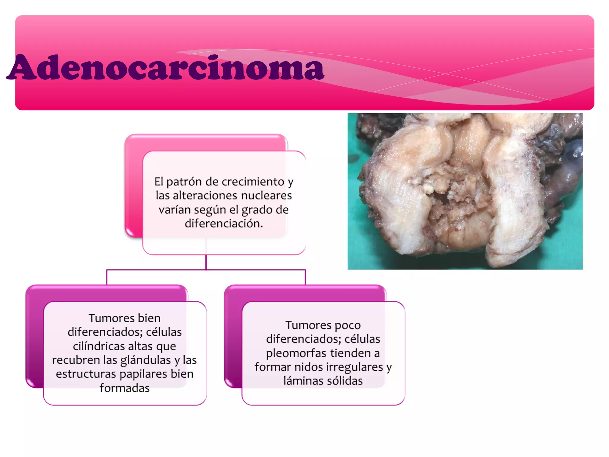 Adenocarcinoma
 