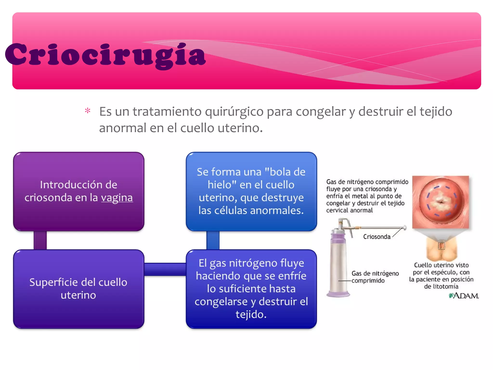 ∗ Es un tratamiento quirúrgico para congelar y destruir el tejido
anormal en el cuello uterino.
Criocirugía
 