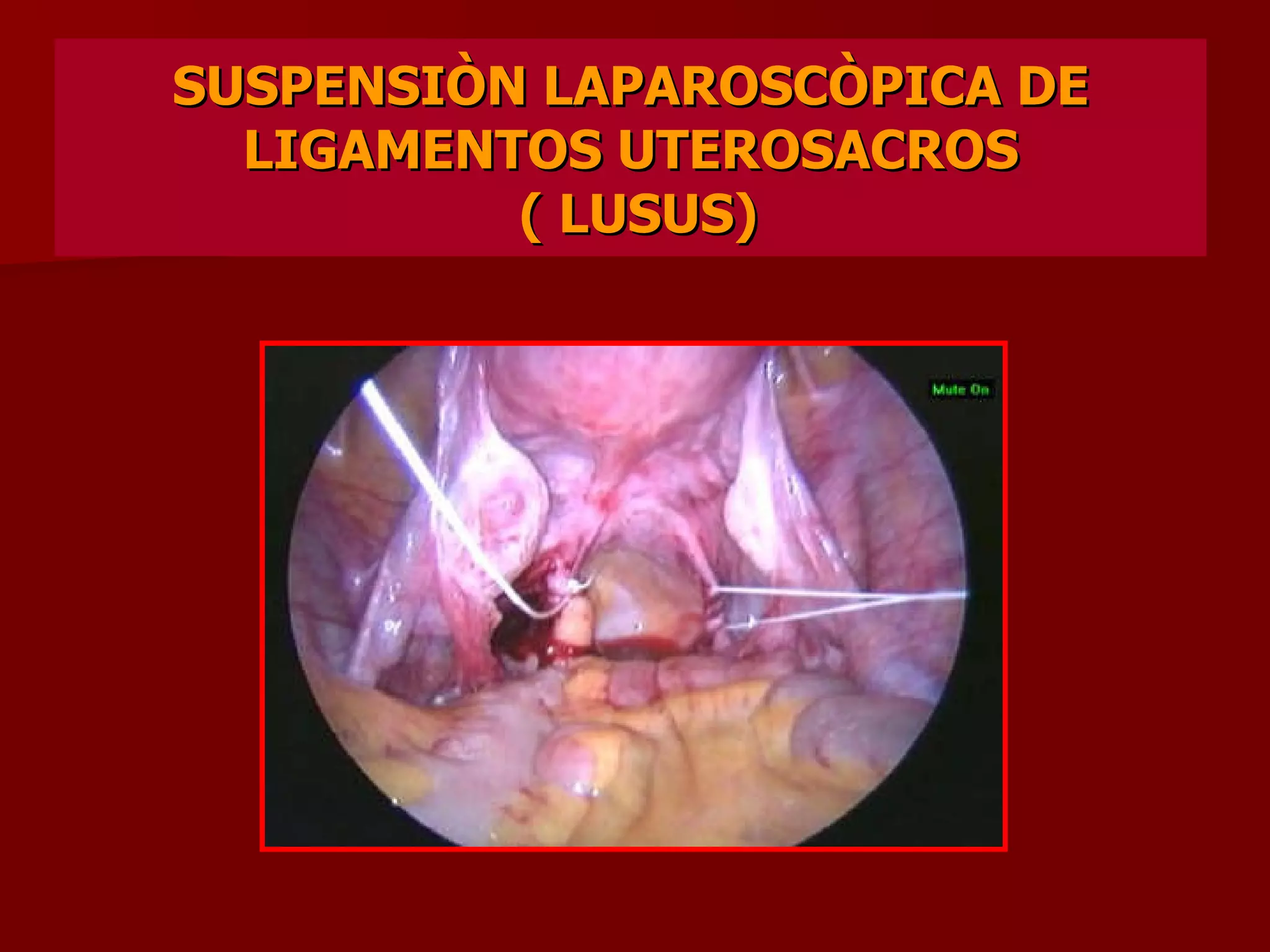 SUSPENSIÒN LAPAROSCÒPICA DE LIGAMENTOS UTEROSACROS  ( LUSUS) 