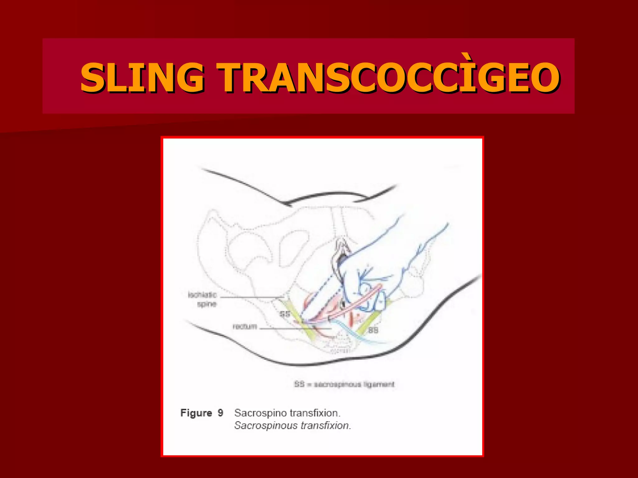 SLING TRANSCOCCÌGEO 
