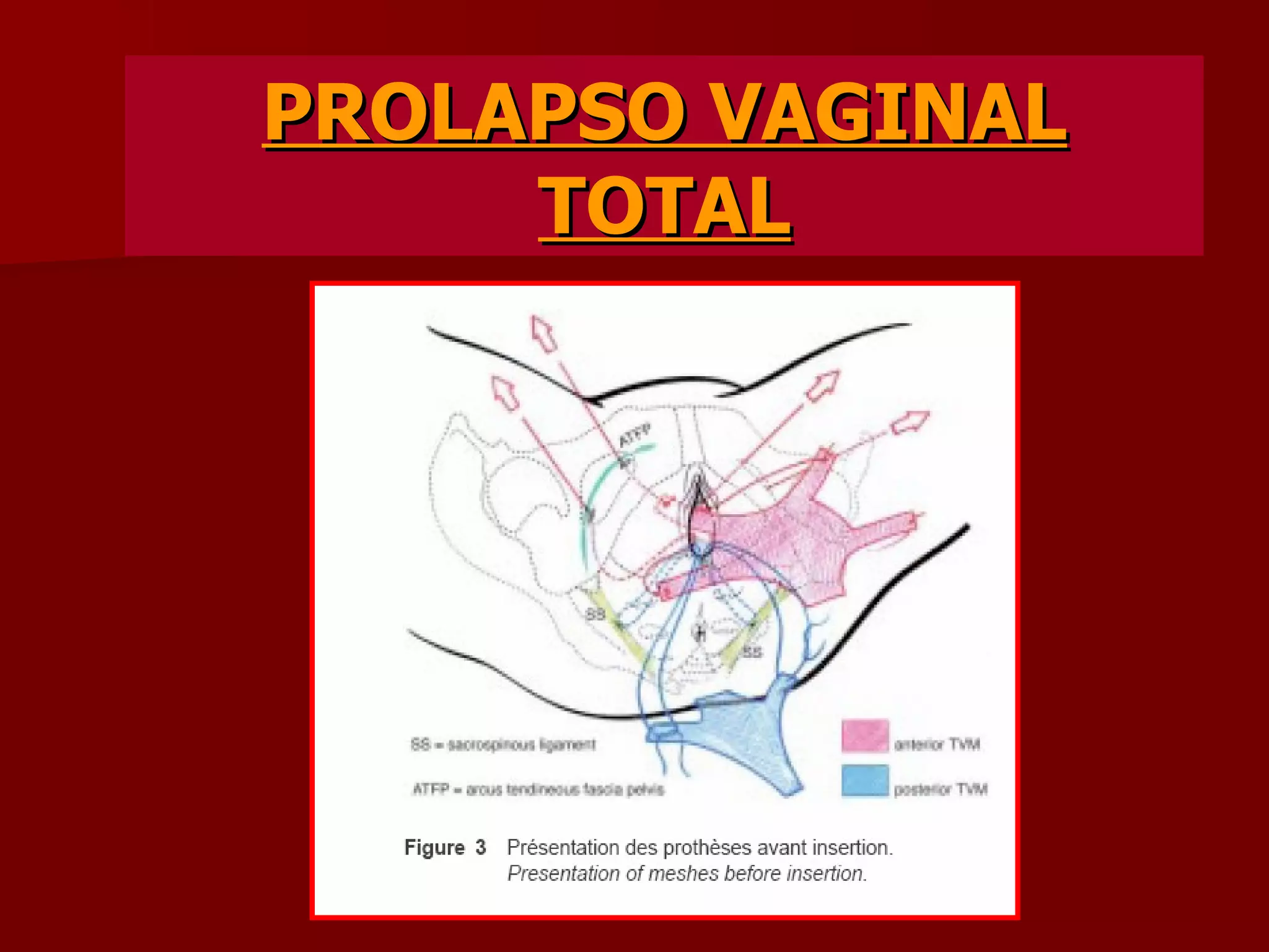 PROLAPSO VAGINAL TOTAL 