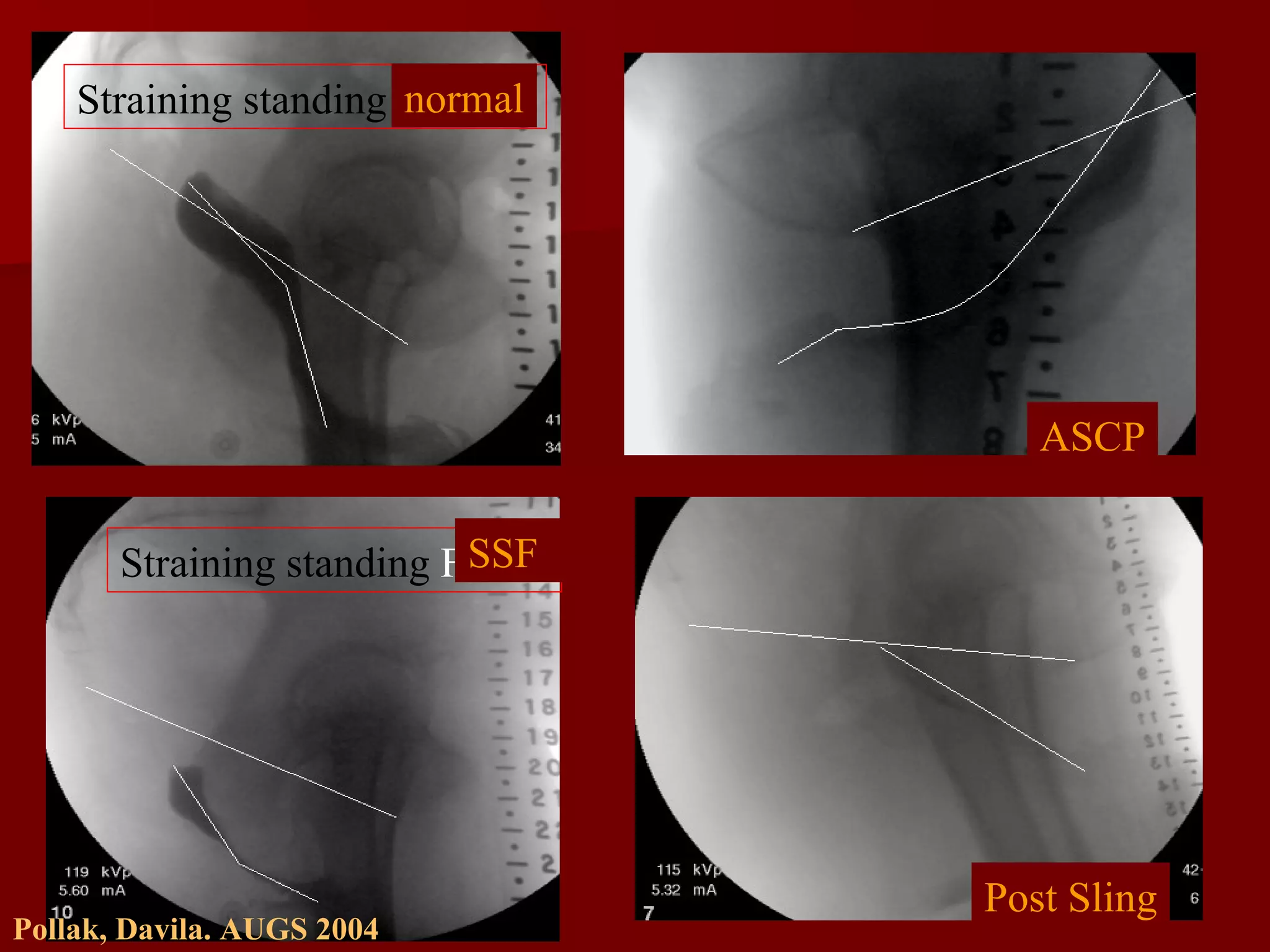 normal ASCP SSF Post Sling Pollak, Davila. AUGS 2004 Straining standing  Kettwig Straining standing  Fallon 