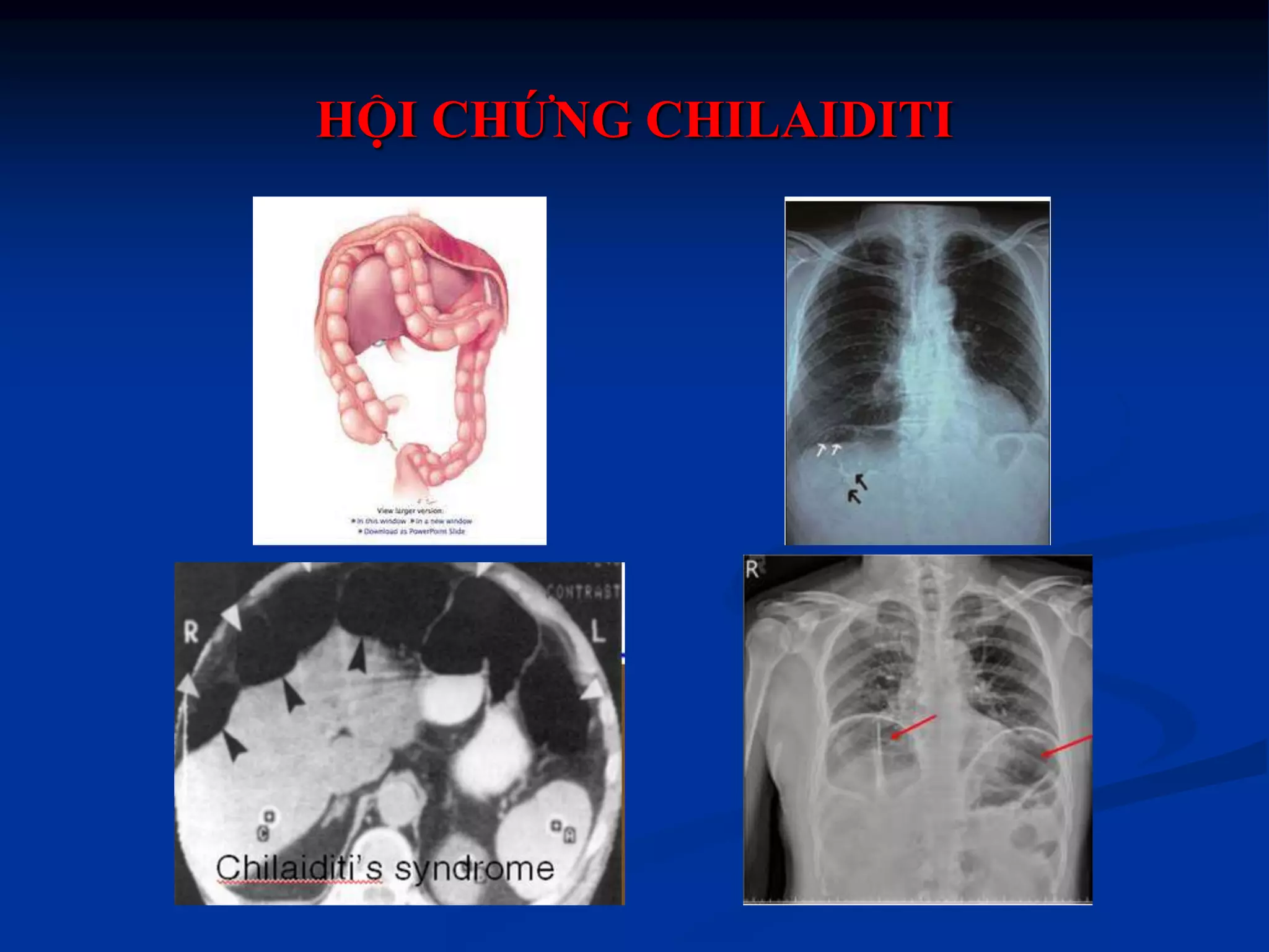 HỘI CHỨNG CHILAIDITI
 