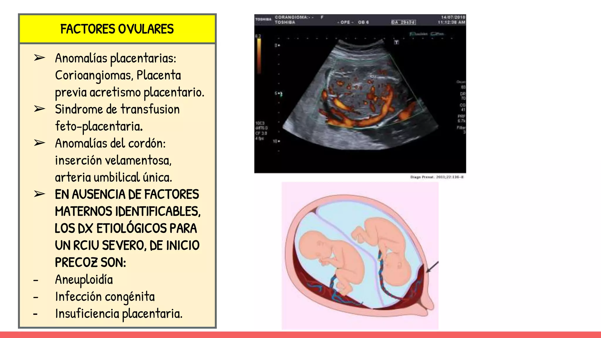 FACTORES OVULARES
➢ Anomalías placentarias:
Corioangiomas, Placenta
previa acretismo placentario.
➢ Sindrome de transfusion
feto-placentaria.
➢ Anomalías del cordón:
inserción velamentosa,
arteria umbilical única.
➢ EN AUSENCIA DE FACTORES
MATERNOS IDENTIFICABLES,
LOS DX ETIOLÓGICOS PARA
UN RCIU SEVERO, DE INICIO
PRECOZ SON:
- Aneuploidía
- Infección congénita
- Insuficiencia placentaria.
 