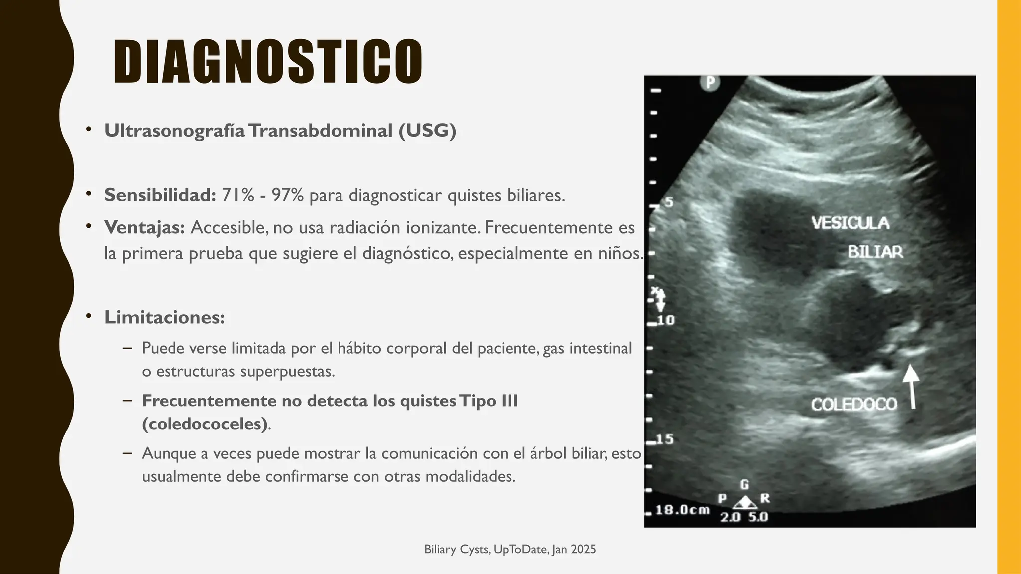 Biliary Cysts, UpToDate, Jan 2025
DIAGNOSTICO
• UltrasonografíaTransabdominal (USG)
• Sensibilidad: 71% - 97% para diagnosticar quistes biliares.
• Ventajas: Accesible, no usa radiación ionizante. Frecuentemente es
la primera prueba que sugiere el diagnóstico, especialmente en niños.
• Limitaciones:
– Puede verse limitada por el hábito corporal del paciente, gas intestinal
o estructuras superpuestas.
– Frecuentemente no detecta los quistesTipo III
(coledococeles).
– Aunque a veces puede mostrar la comunicación con el árbol biliar, esto
usualmente debe confirmarse con otras modalidades.
 