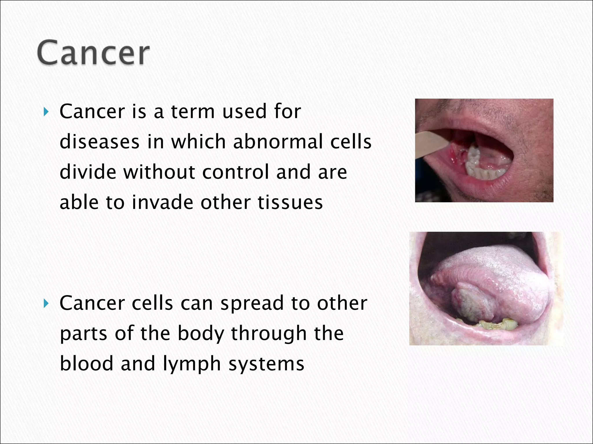 Cancer is a term used for diseases in which abnormal cells divide without control and are able to invade other tissues Cancer cells can spread to other parts of the body through the blood and lymph systems 